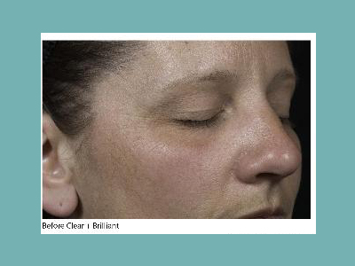 Clear and Brilliant Fraxel Laser Before and After Pictures San Antonio and Boerne, TX