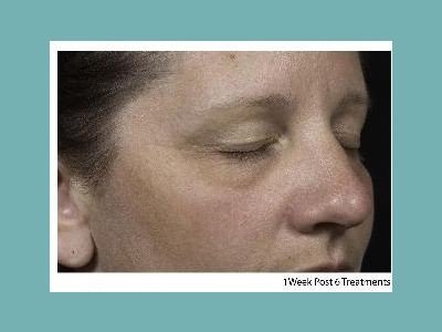 Clear and Brilliant Fraxel Laser Before and After Pictures San Antonio and Boerne, TX