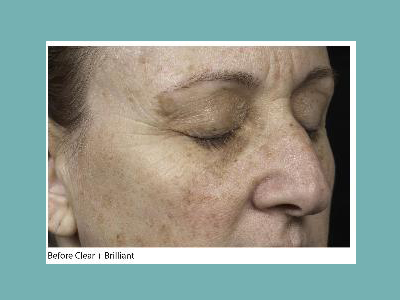 Clear and Brilliant Fraxel Laser Before and After Pictures San Antonio and Boerne, TX