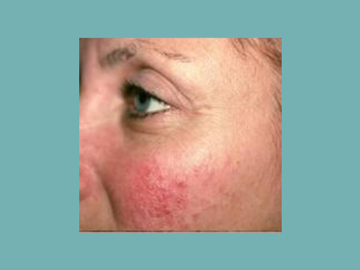 Laser Genesis Before and After Pictures San Antonio and Boerne, TX