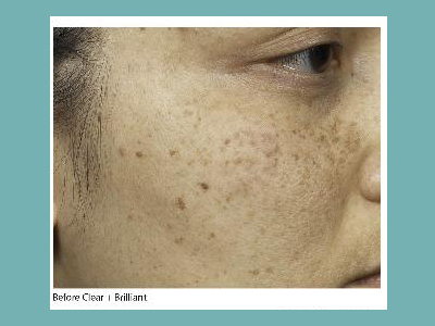 Clear and Brilliant Fraxel Laser Before and After Pictures San Antonio and Boerne, TX