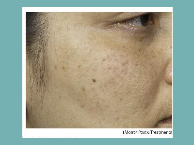 Clear and Brilliant Fraxel Laser Before and After Pictures San Antonio and Boerne, TX