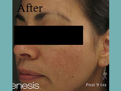 Laser Genesis Before and After Pictures San Antonio and Boerne, TX