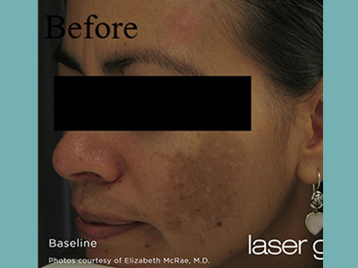 Laser Genesis Before and After Pictures San Antonio and Boerne, TX