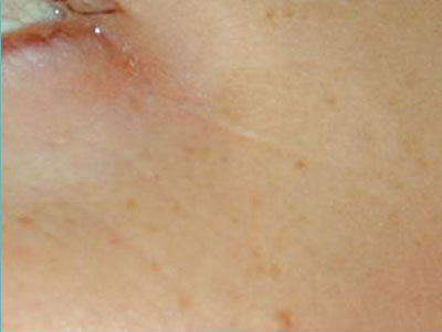 Laser Genesis Before and After Pictures San Antonio and Boerne, TX