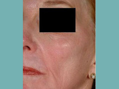 Laser Genesis Before and After Pictures San Antonio and Boerne, TX