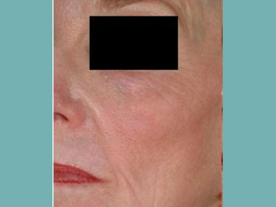 Laser Genesis Before and After Pictures San Antonio and Boerne, TX