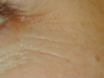 Laser Genesis Before and After Pictures San Antonio and Boerne, TX