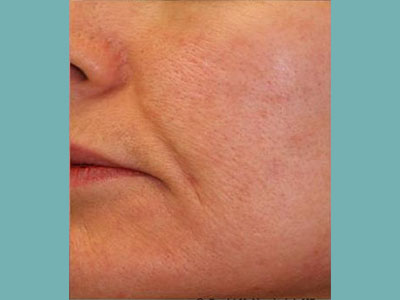 Laser Genesis Before and After Pictures San Antonio and Boerne, TX