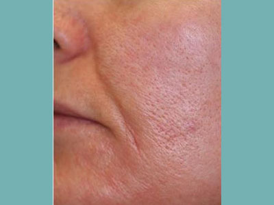 Laser Genesis Before and After Pictures San Antonio and Boerne, TX