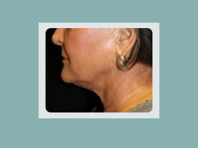 Kybella® Before and After Pictures San Antonio and Boerne, TX