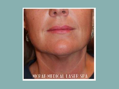 Kybella® Before and After Pictures San Antonio and Boerne, TX